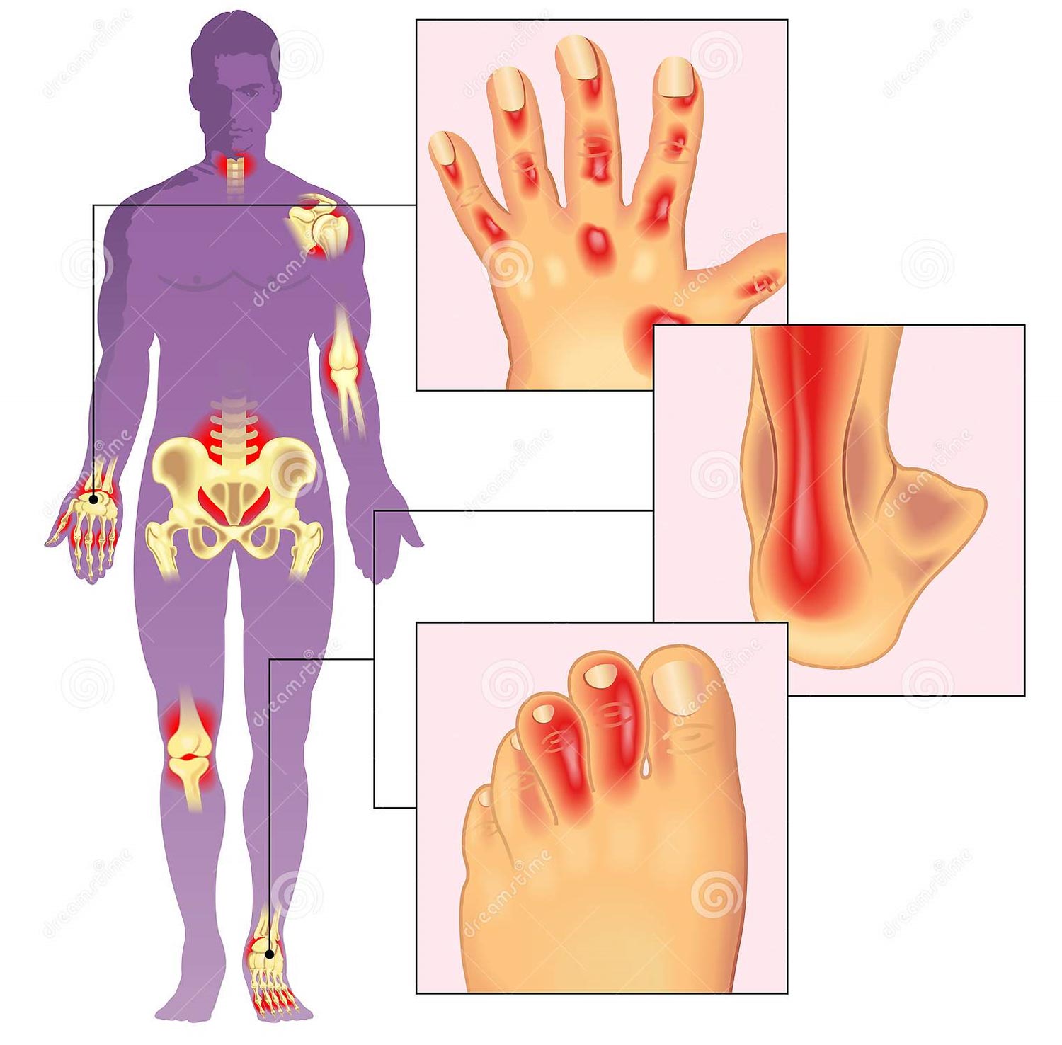 inflamația articulară în artrita picioarelor
